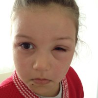 Food allergies contact reaction swelling